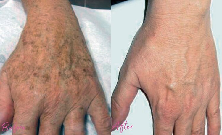 Melbourne Pigmentation Removal