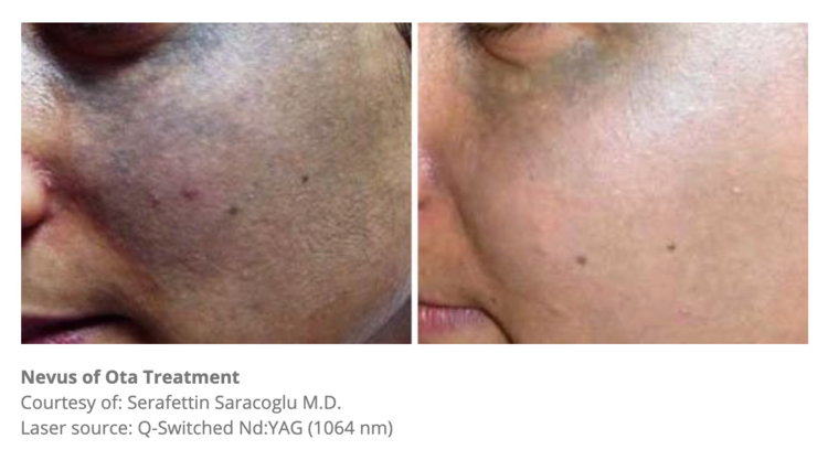 Pigmentation Removal Melbourne