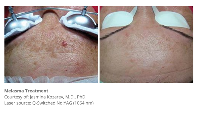 Laser removal pigmentation melbourne