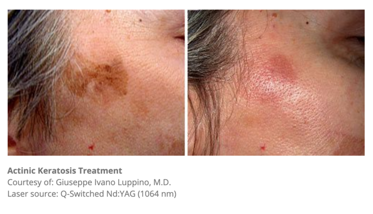 Laser Pigmentation Removal Melbourne